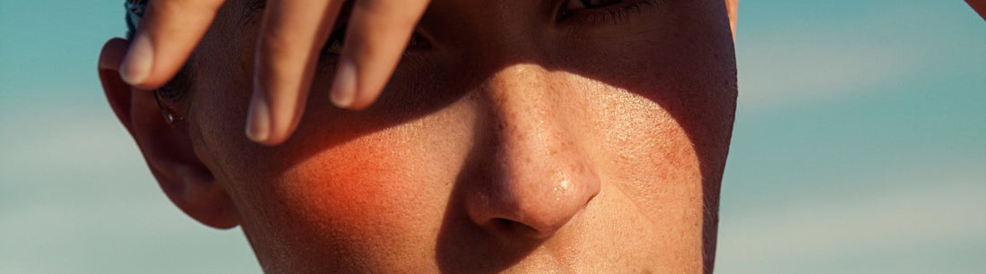 Redness -  Rosacea