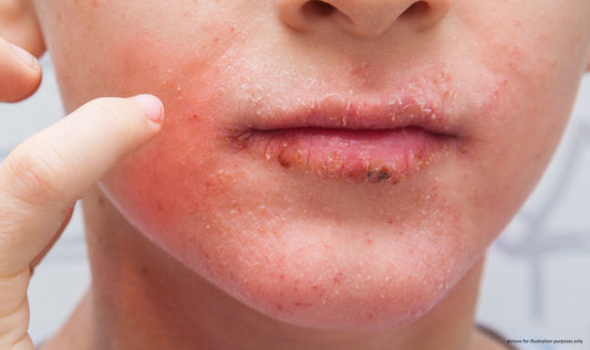 young adult skin showing flakes and skin irritation - skin reaction retinol - DeMay Skin Care