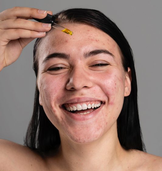 Oils on oily, breakout-prone skin